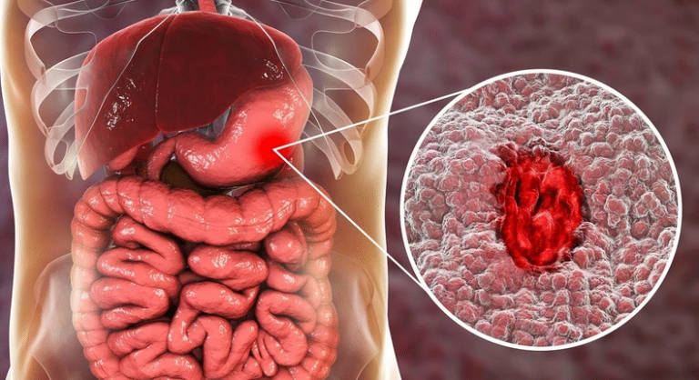 6 Symptoms of Stomach Ulcer