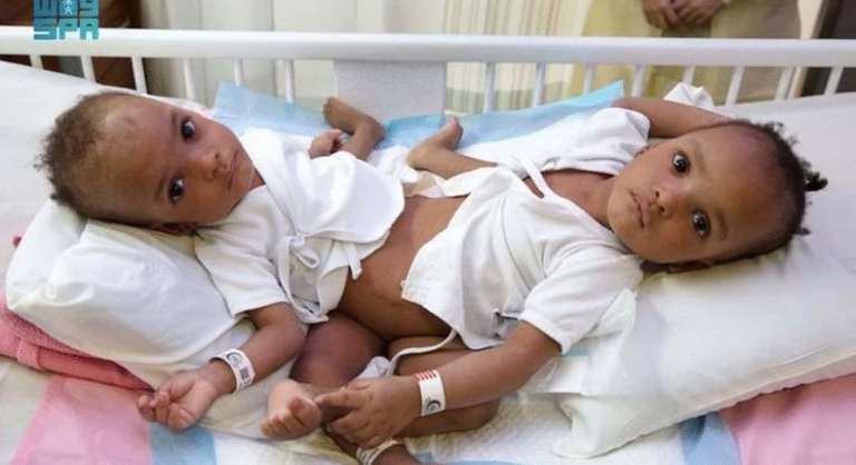 BREAKING: Conjoined Nigerian twins successfuly separated in Saudi Arabia