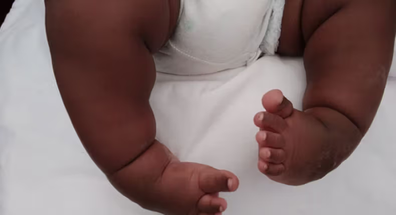 Expert warns parents against abandoning children with clubfoot deformity, says its treatable